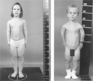Acromesomelic Dysplasia | Dr. Pooja’s Homeopathy