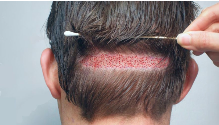 The Ultimate Guide to Hair Transplant in Pakistan
